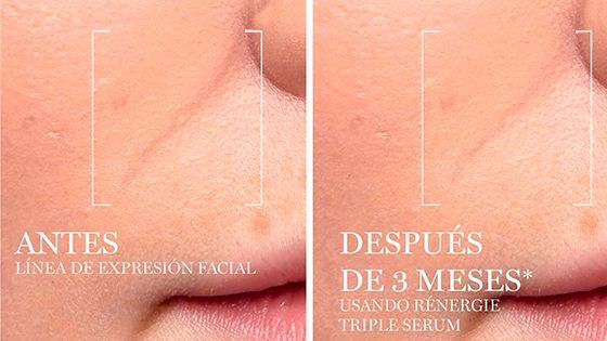 Resultados Triple Serum