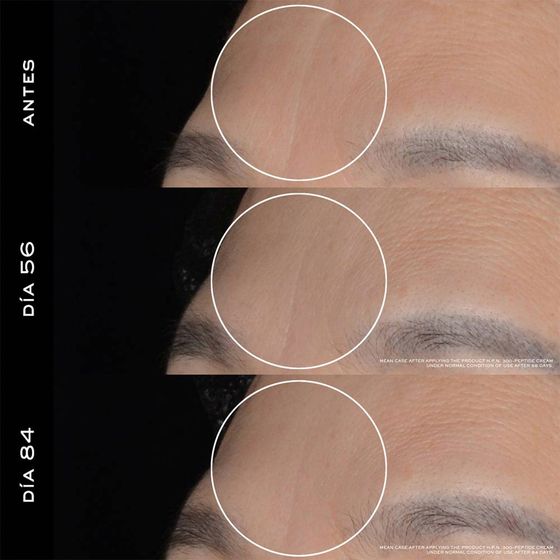 LIFTING FACIAL Y DE CUELLO