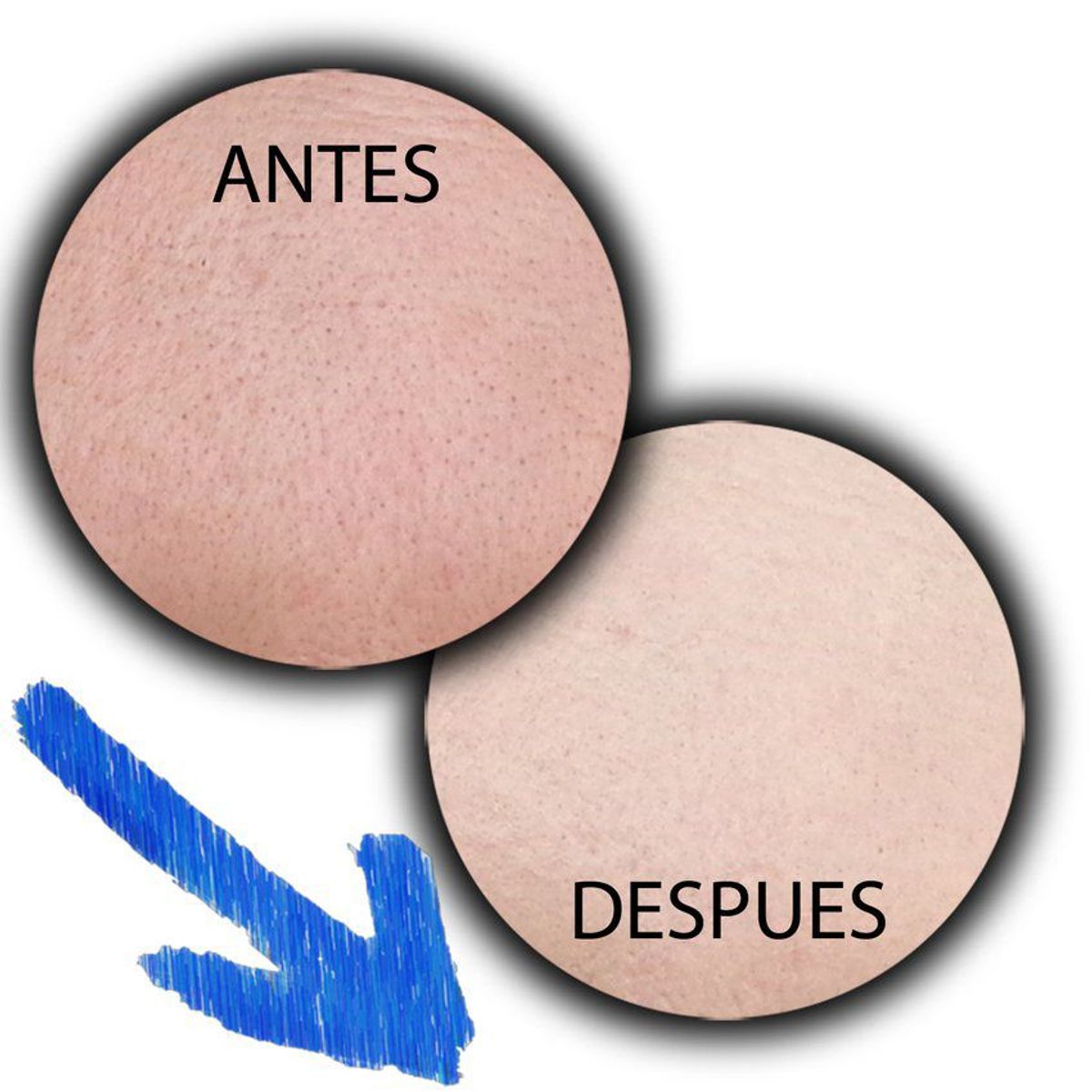 PURA - Derma roller celulitis arrugas cicatrices acné