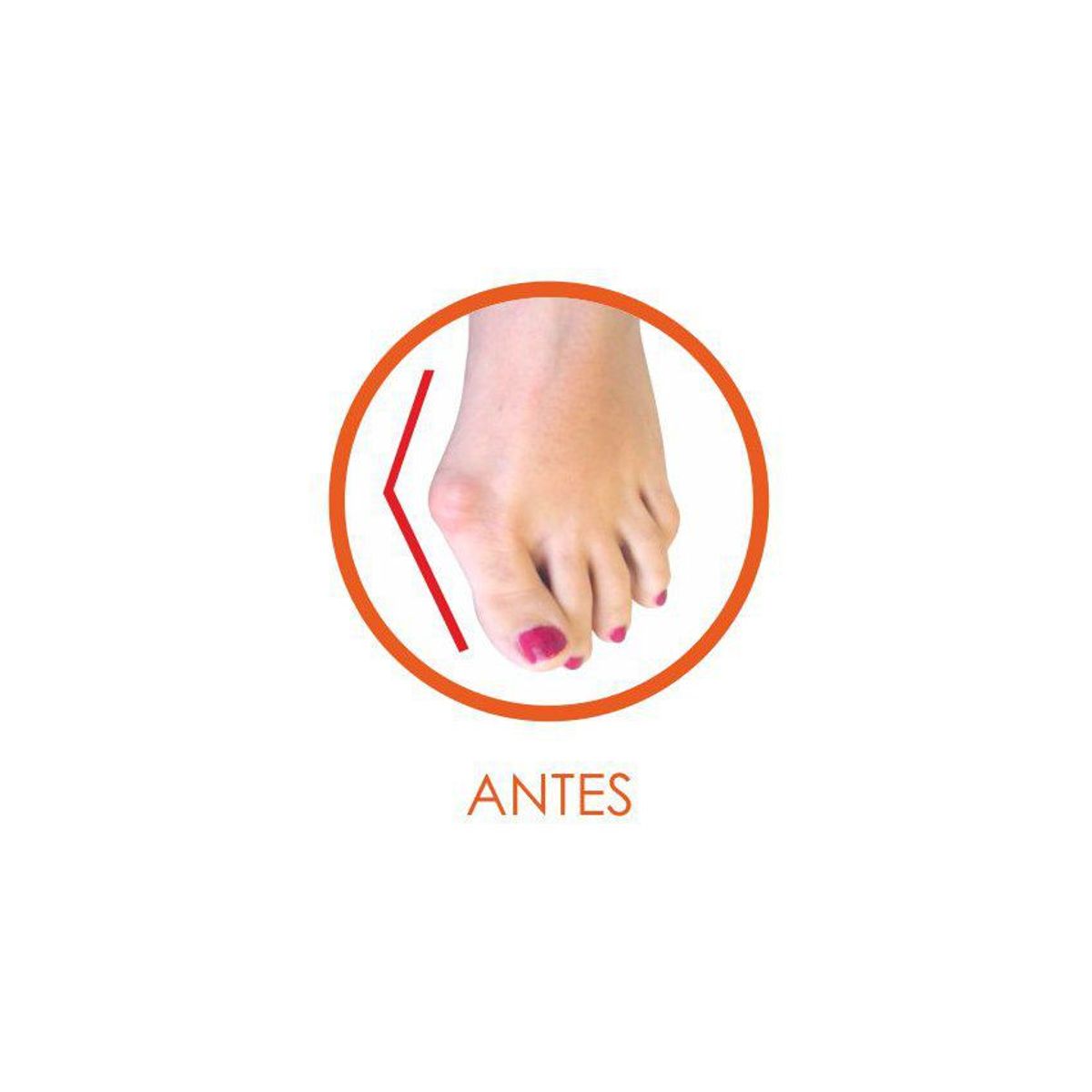 UTESLA - Protector de juanetesuteslaseparador siliconadoudefense