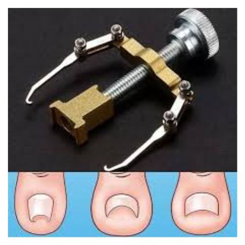 GENERICO - Corrector de Uñas Encarnadas.