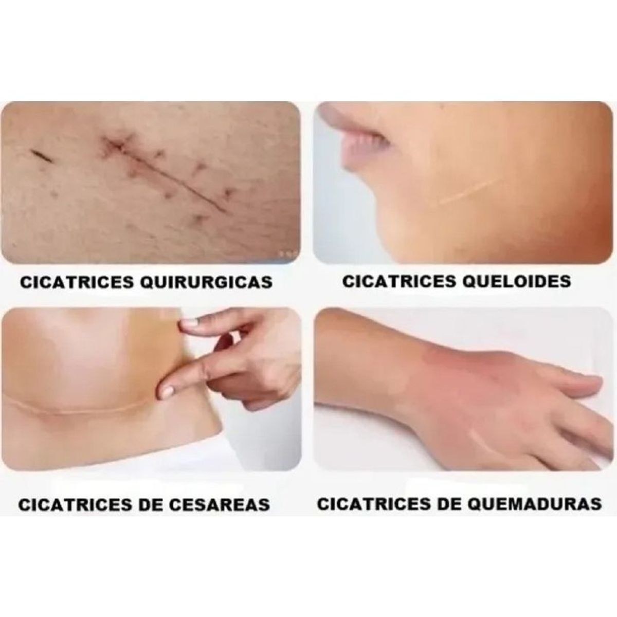 GENERICO - Parche de silicona para eliminar cicatrices x 15 cms largo