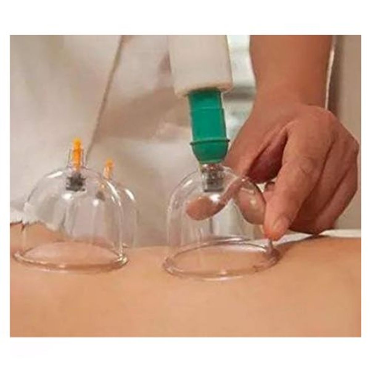 GENERICO - Set de ventosas vacum terapia.