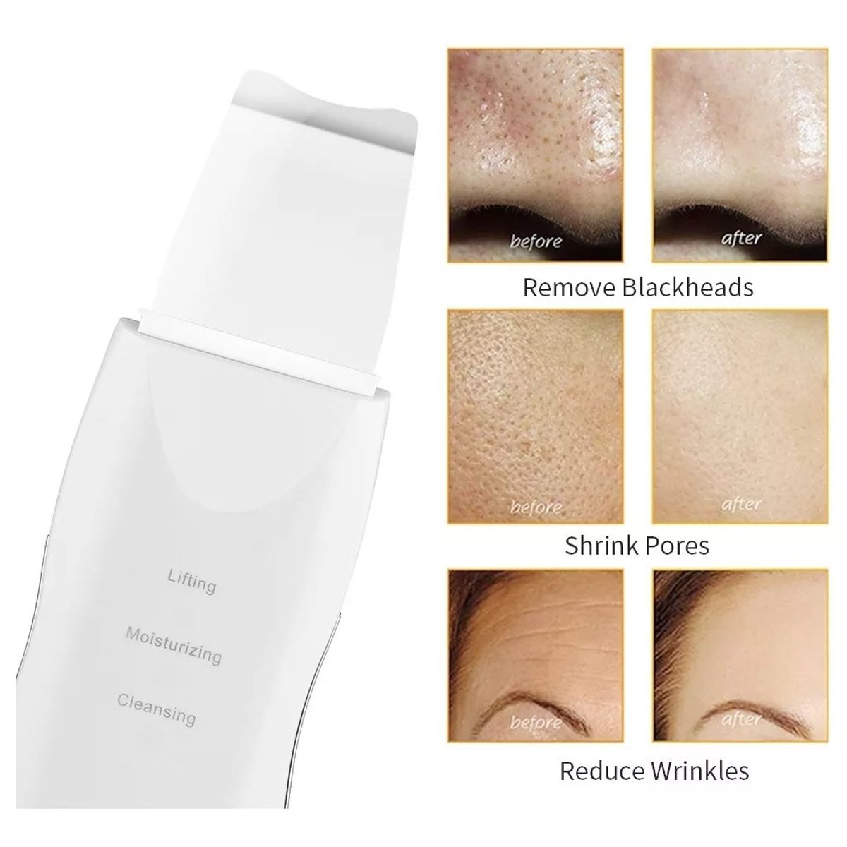 GENERICO - Espatula Peeling Ultrasonico Limpiador Facial Lifting