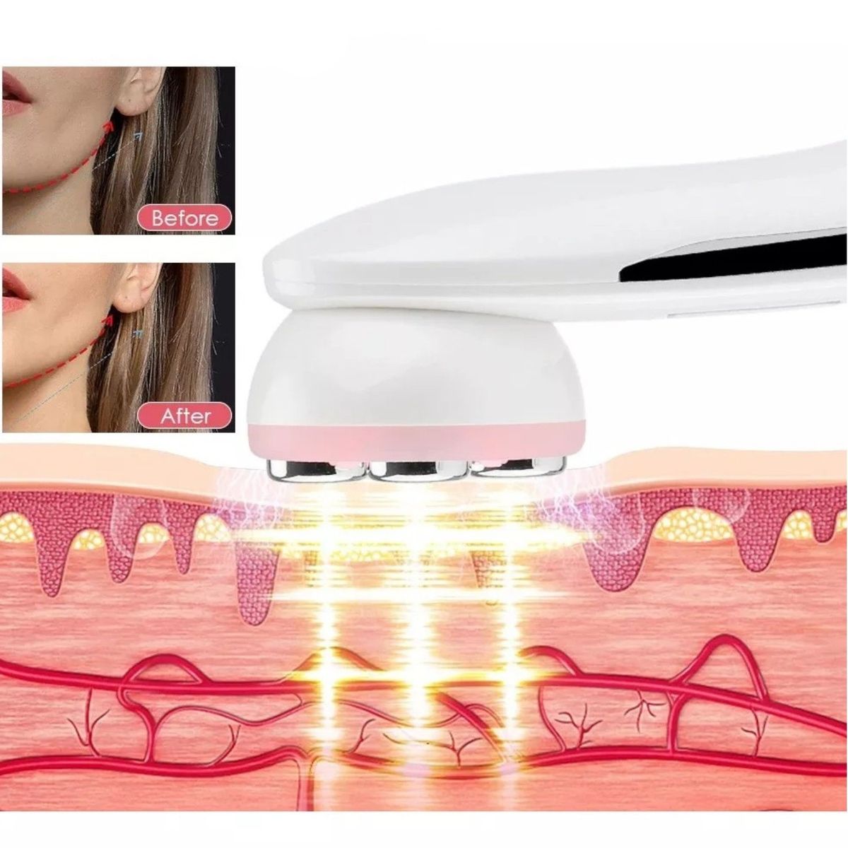 GENERICO - Radio Frecuencia Facial para Rejuvenecer y Tensar la Piel