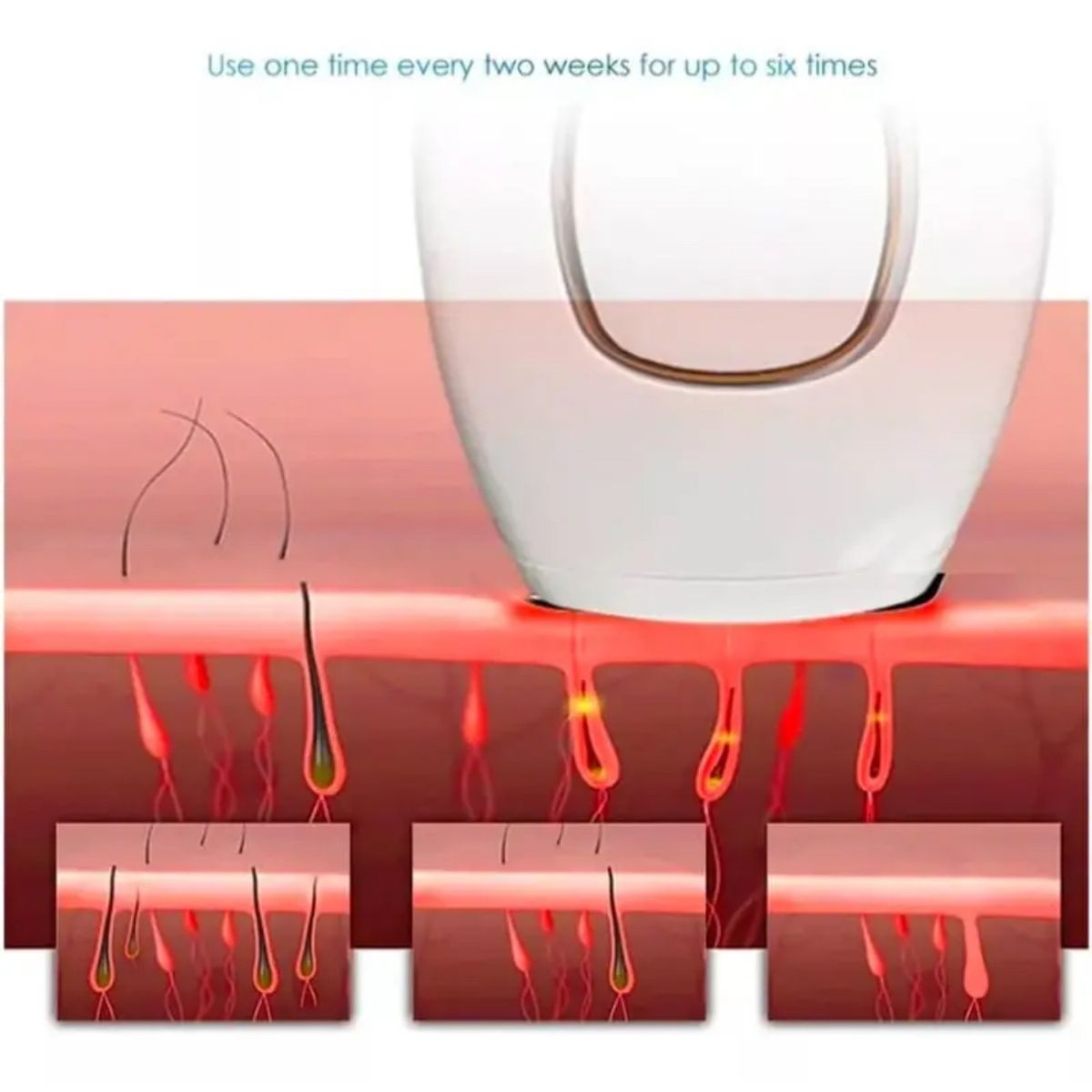 AMERICAN GENERICS - DEPILADORA LASER IPL- DESTELLOS SIN DOLOR