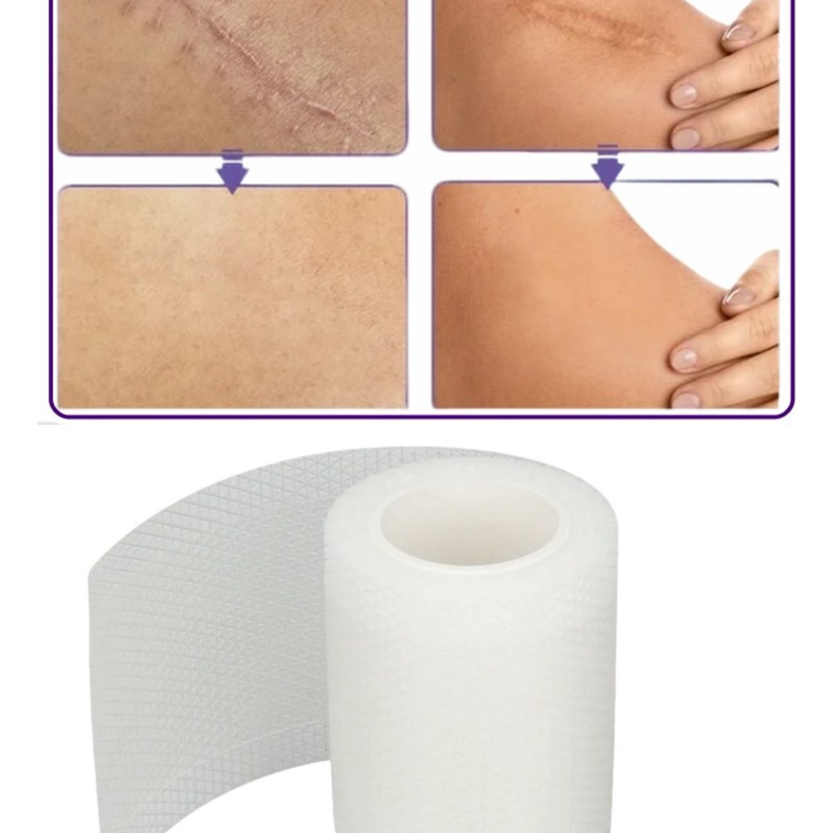 GENERICO - Cinta Silicona Para Cicatrices 15M X 4CM x2 Rollos