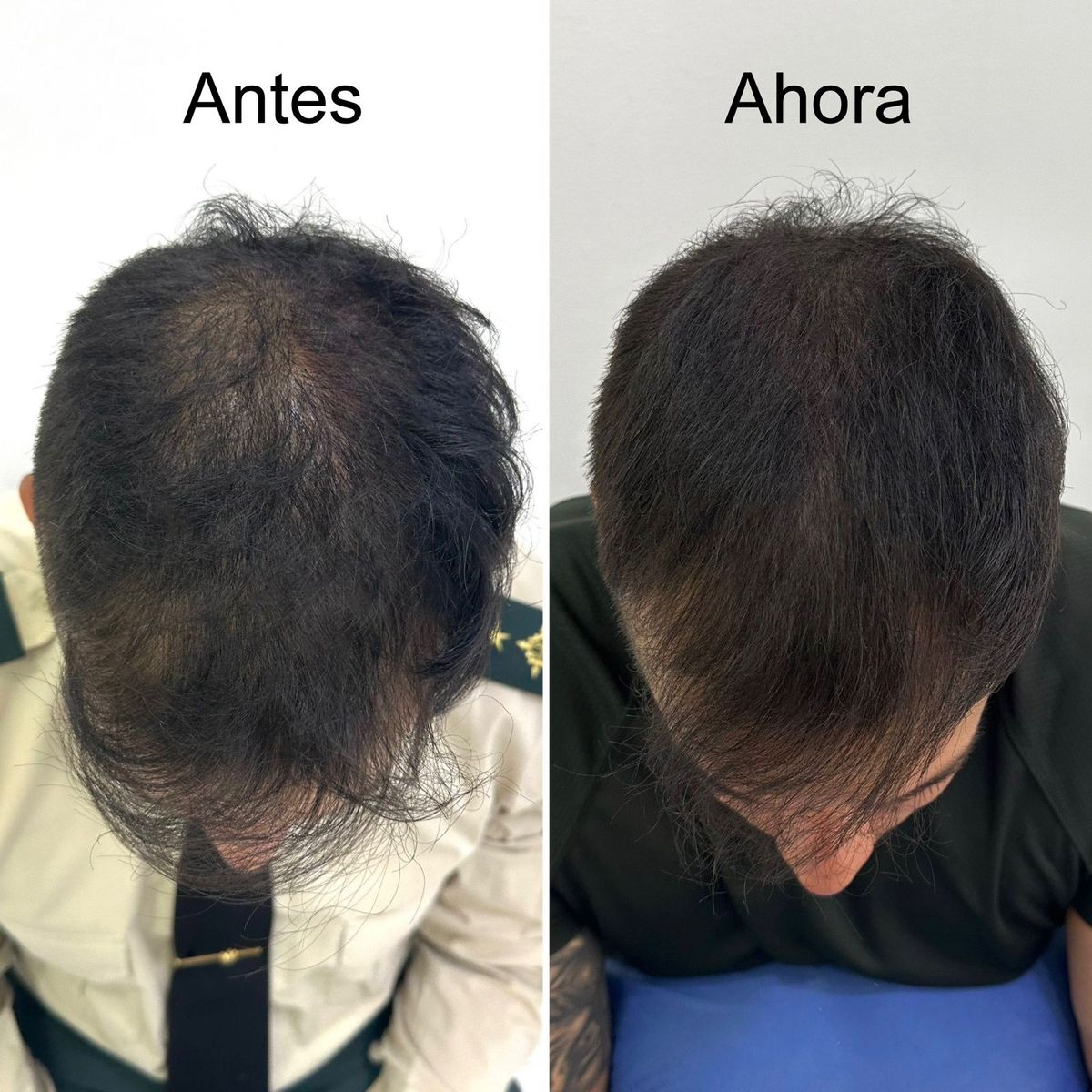 HAIR2YOU - Pague 2 lleve 3 Loción Capilar contra la caída del cabello