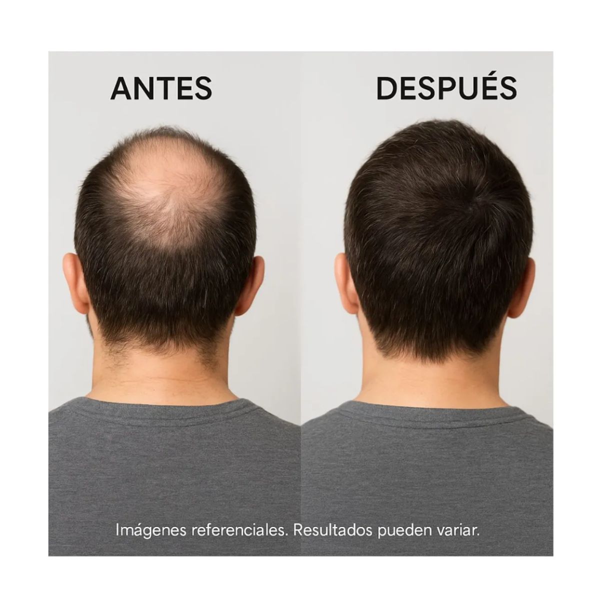 SIGNATURE - Pack Original 3 Minoxidil Kirkland 5% – Crecimiento Barba y Cabello