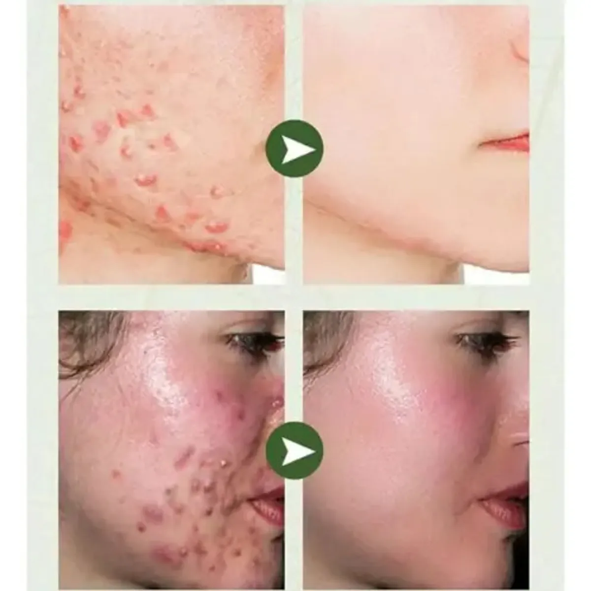 BIOAQUA - Crema Ácido Salicílico Bioaqua Control Acné Piel Grasa