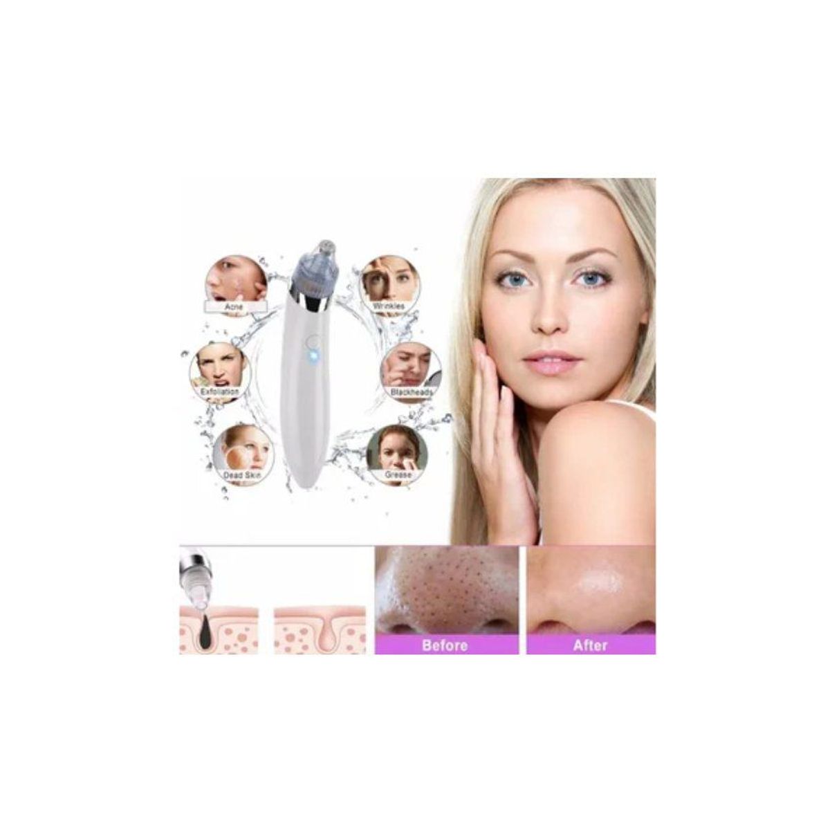 GENERICO - Limpiador facial succionador puntos negro aspirador de acné espinilla