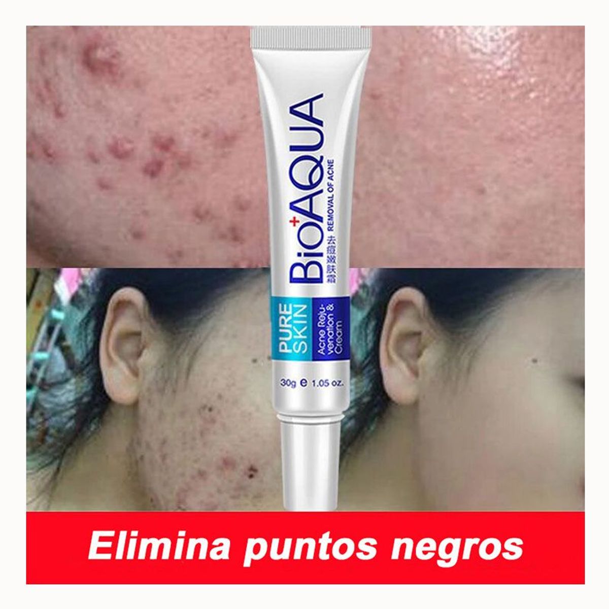 BIOAQUA - BioAqua para acné espinillas y puntos negros - Crema Antiacné_123