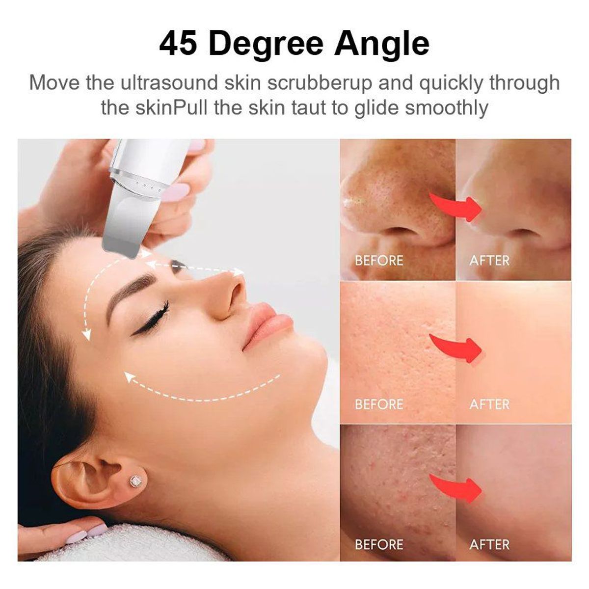 OEM - Limpiador Facial Espátula Quita Espinillas ULTRASONICO