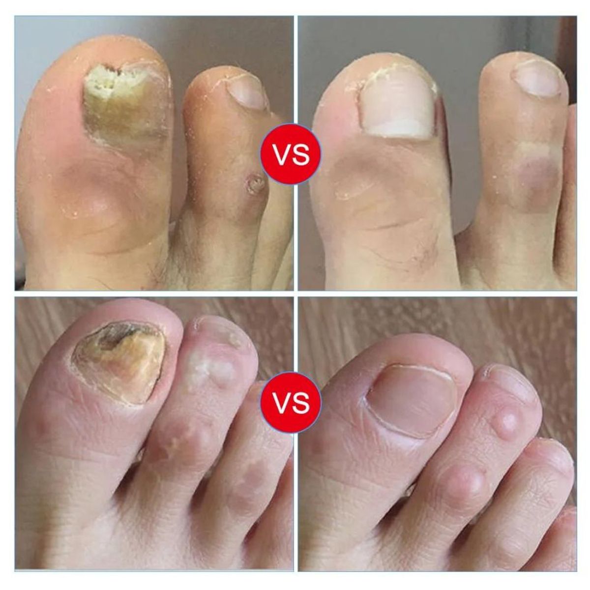 GENERICO - Lápiz Reparador de Uñas de los Pies y Manos - LEUCONYCHIA