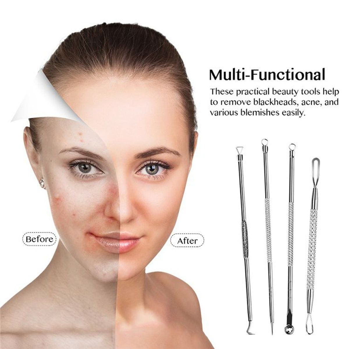 GENERICO - KIT EXTRACTOR DE ESPINILLAS, ACNE - 4 PIEZAS