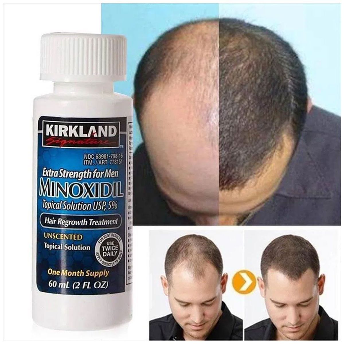 KIRKLAND - Minoxidil Kirkland 5% 1 frasco/ 1 mes y gotero - barba y cabello