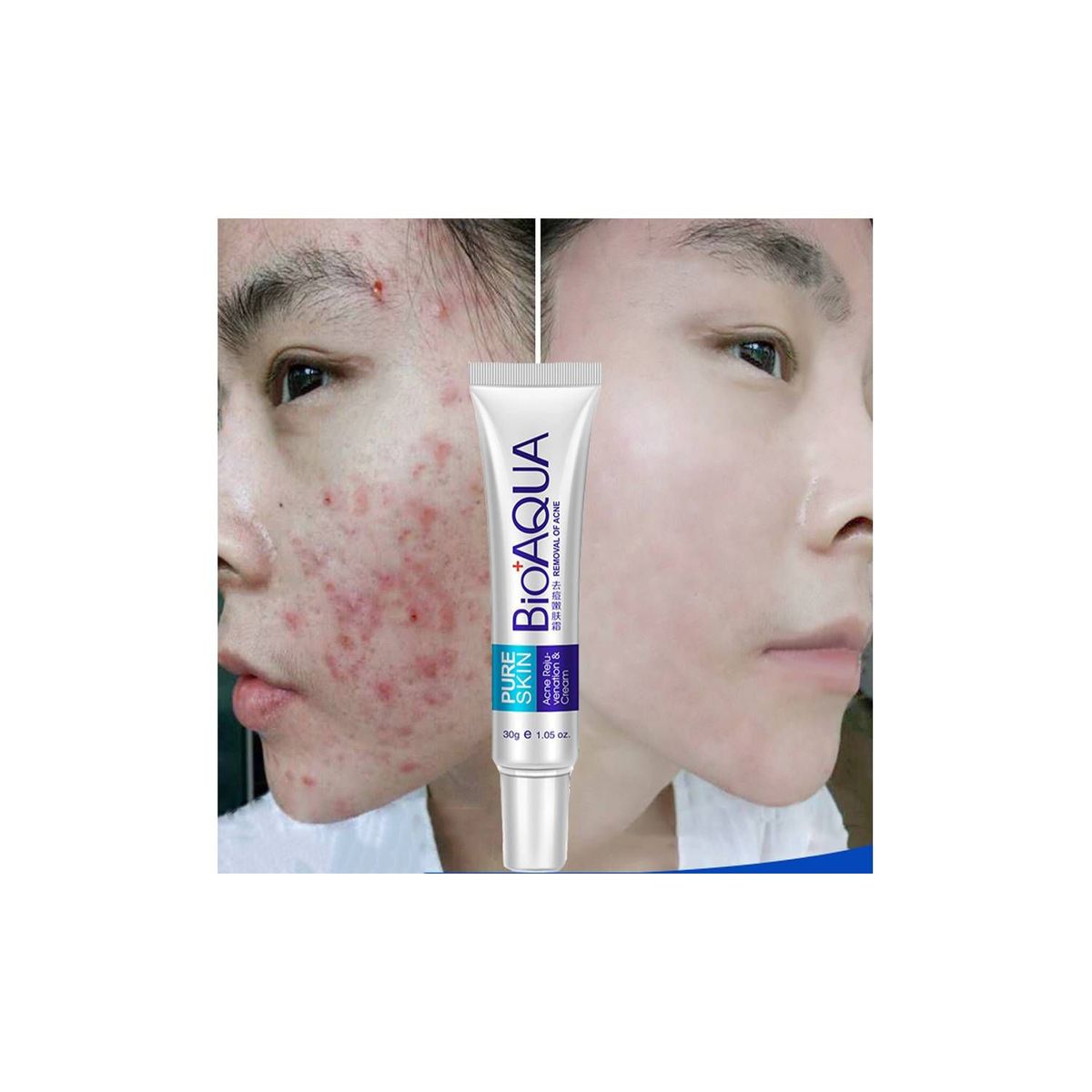 BIOAQUA - Crema Anti-Acné elimina espinillas y puntos negros - BIOAQUA