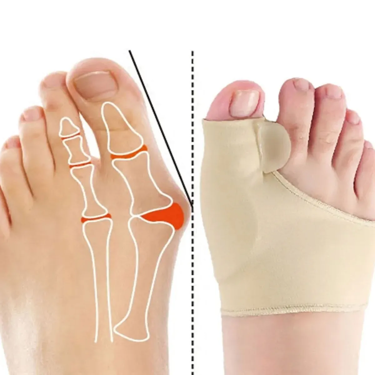 GENERICO - Corrector De Juanetes, Vendaje Ortopédico, 1 Par