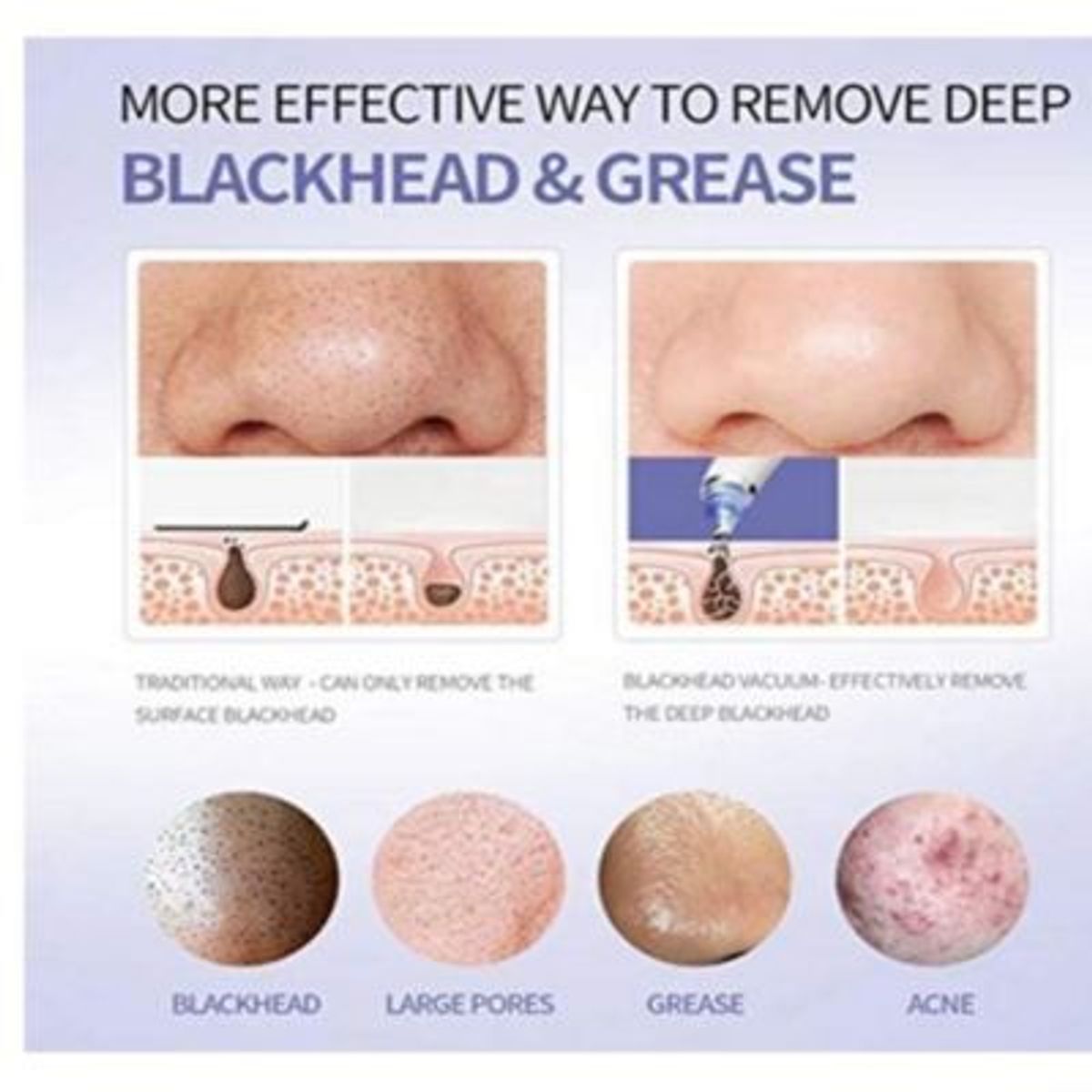 GENERICO - Removedor Succionador de Espinillas Acne Cuidado Facial Derma Suction