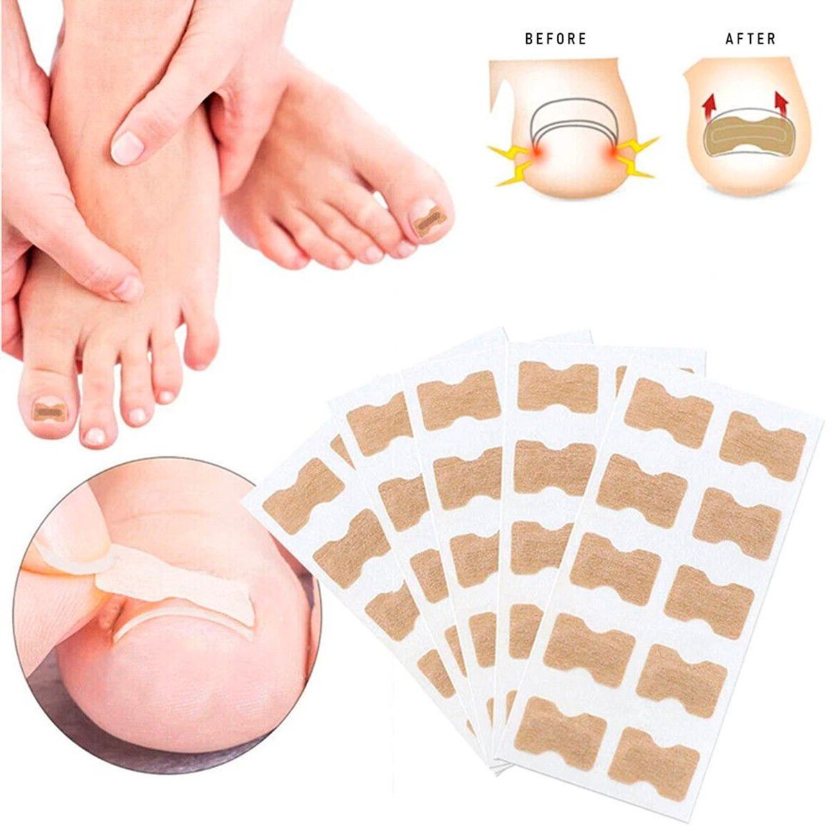 GENERICO - Pack 30 Parche Corrector de Uña Encarnada