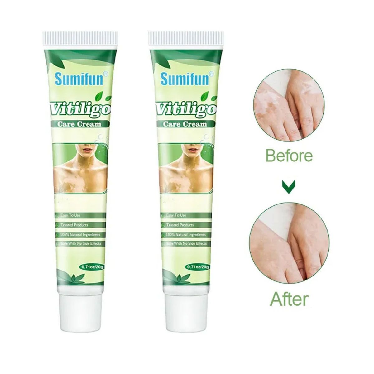 GENERICO - Crema Para Vitiligo 2 UND