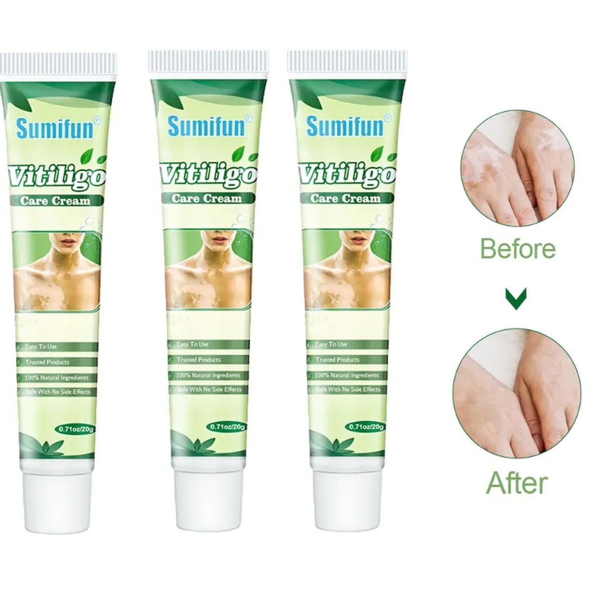 GENERICO - Crema Natural China Para Tratar Vitíligo 3 UND