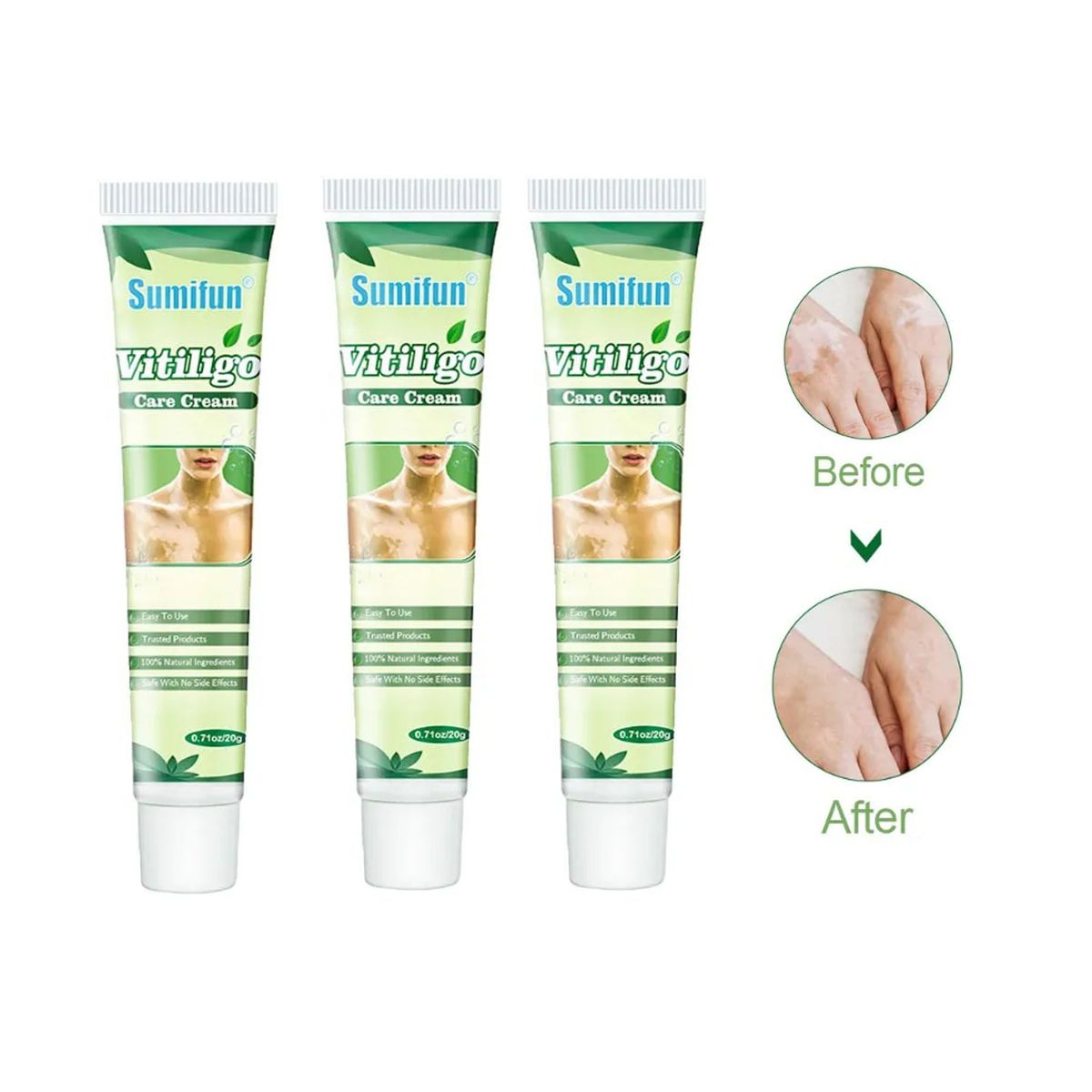 GENERICO - Crema Natural China Para Tratar Vitíligo 3 UND