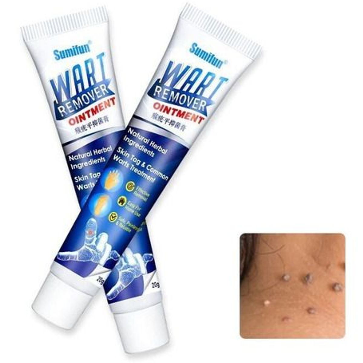 GENERICO - Crema removedora de verrugas VPH y acrocordones