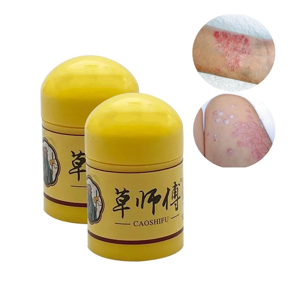 GENERICO - Pomada natural para soriasis Dermatitis eccemas 10gr