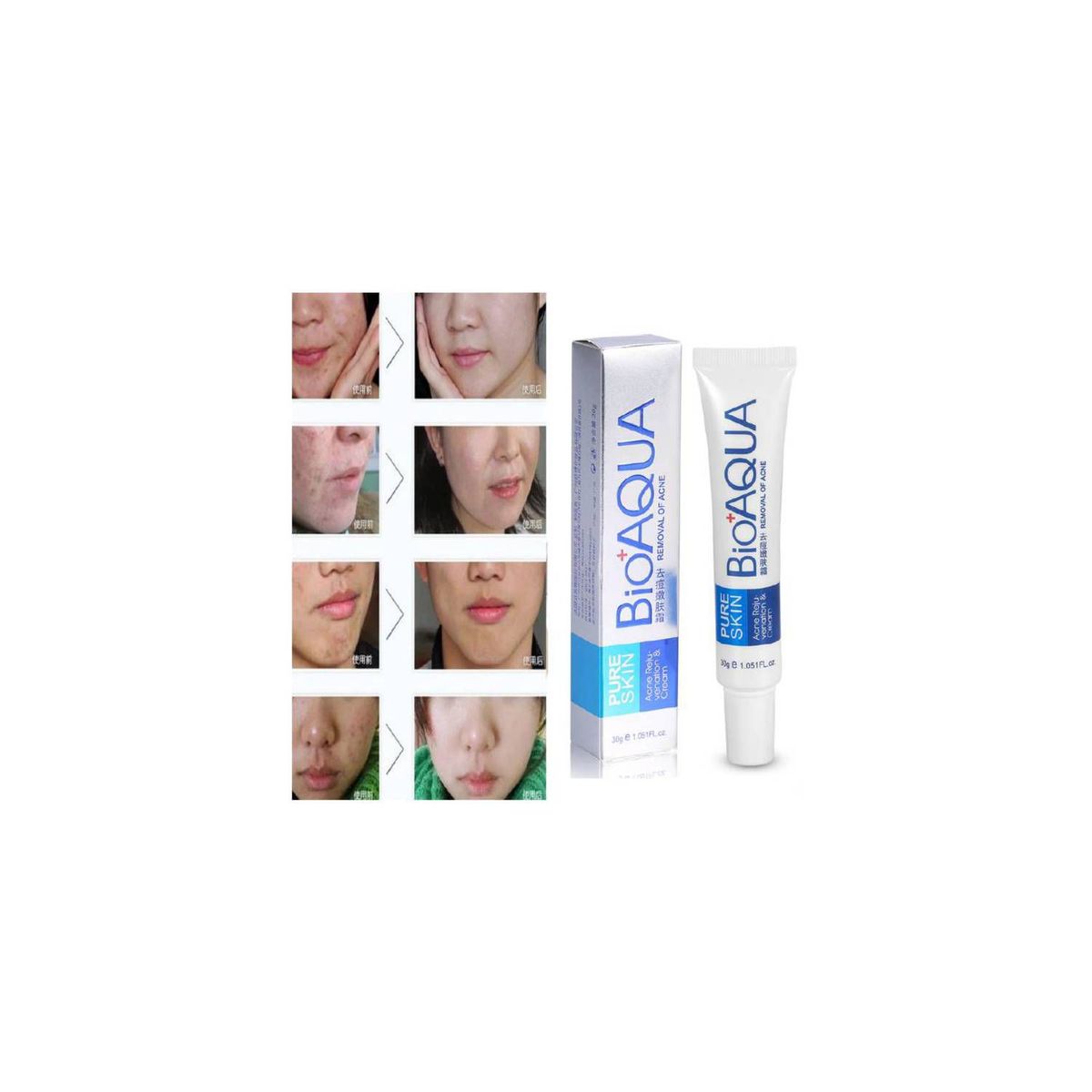 BIOAQUA - PACK 3 CREMA ANTIACNÉ ELIMINA ESPINILLAS Y PUNTOS NEGROS BIOAQUA