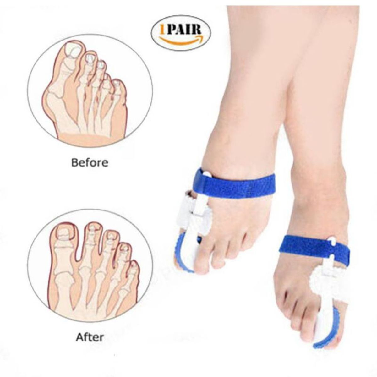 GENERICO - Férula para Juanete Corrector Alivia Dolor x 2 uni