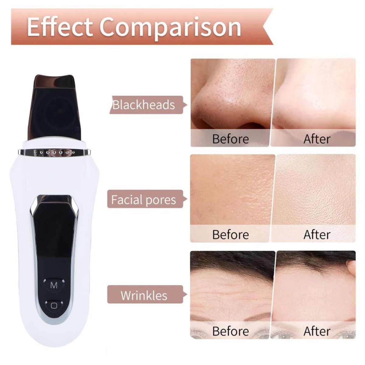 GENERICO - Limpiador Facial Espátula Ultrasónico Limpieza Profunda 4 Modos