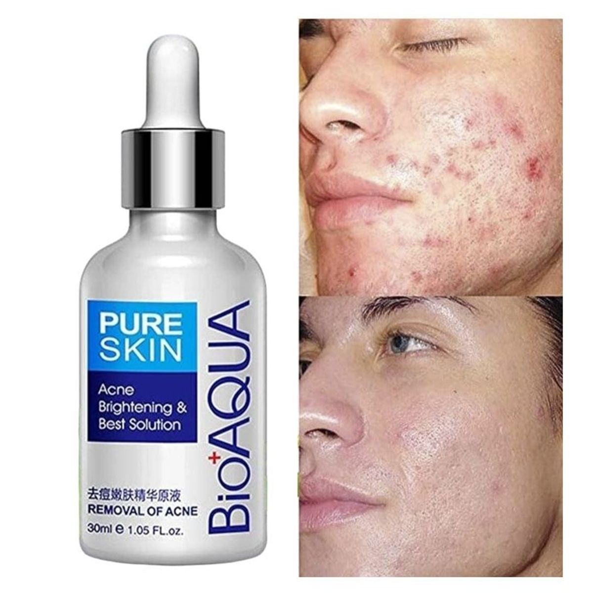 BIOAQUA - BioAqua Suero Aclarante Y Humectante Facial Anti-acné_123