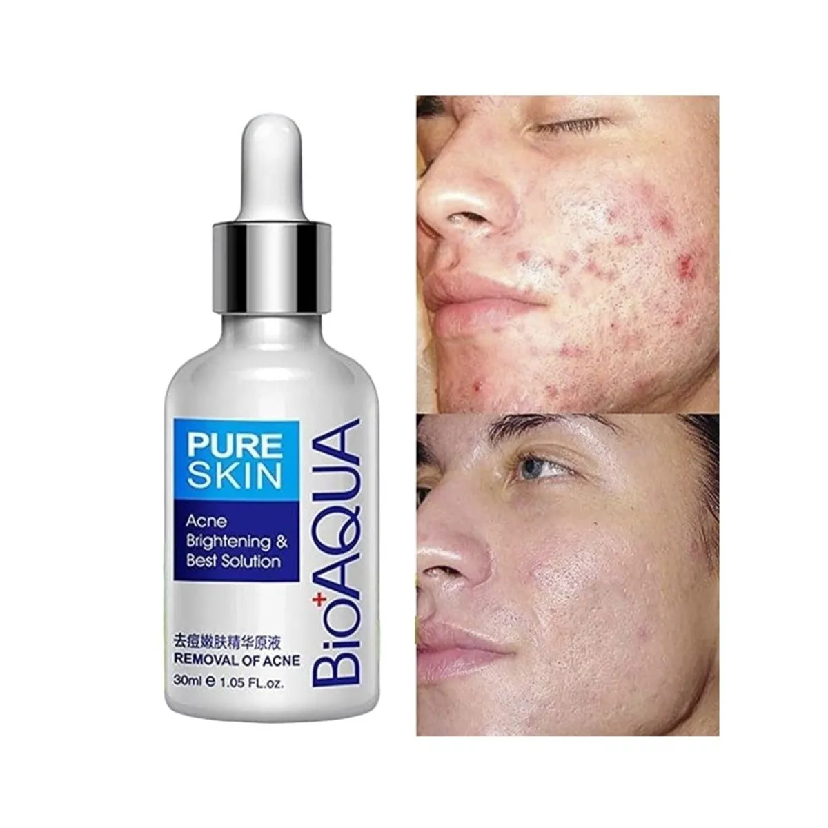 BIOAQUA - BioAqua Suero Aclarante Y Humectante Facial Anti-acné_123