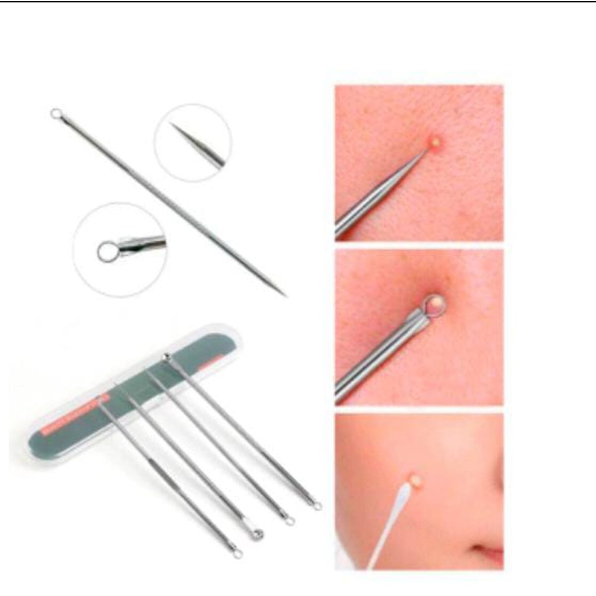 GENERICO - Removedor de Espinillas Granos Quita Acné y Puntos Negros