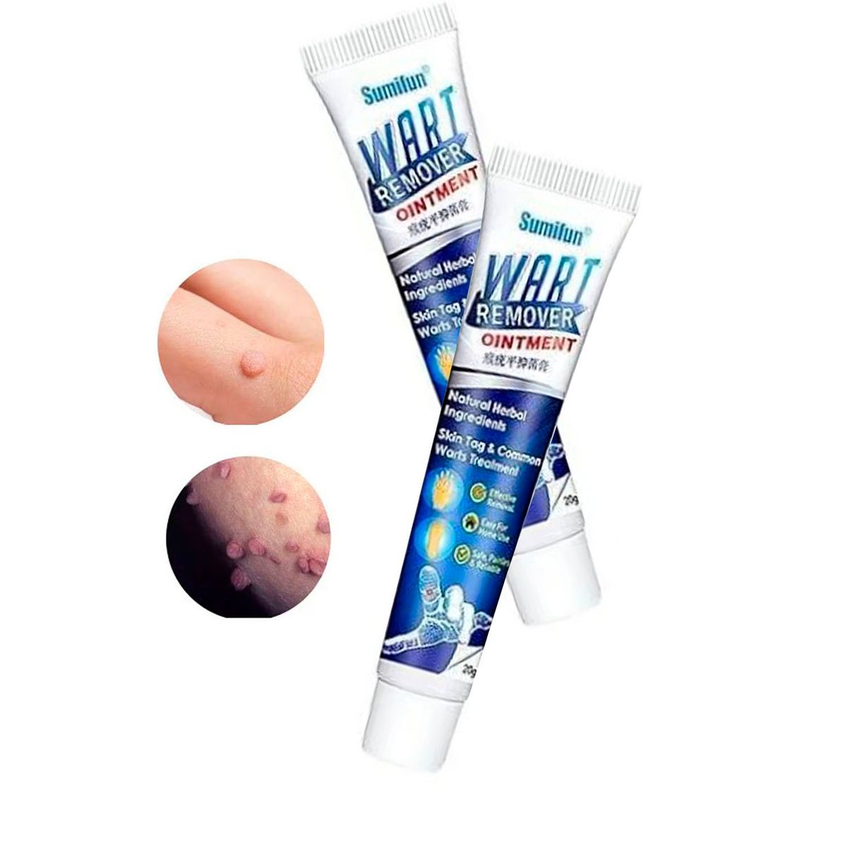 GENERICO - Sumifun wart removedor de verrugas y papilomas