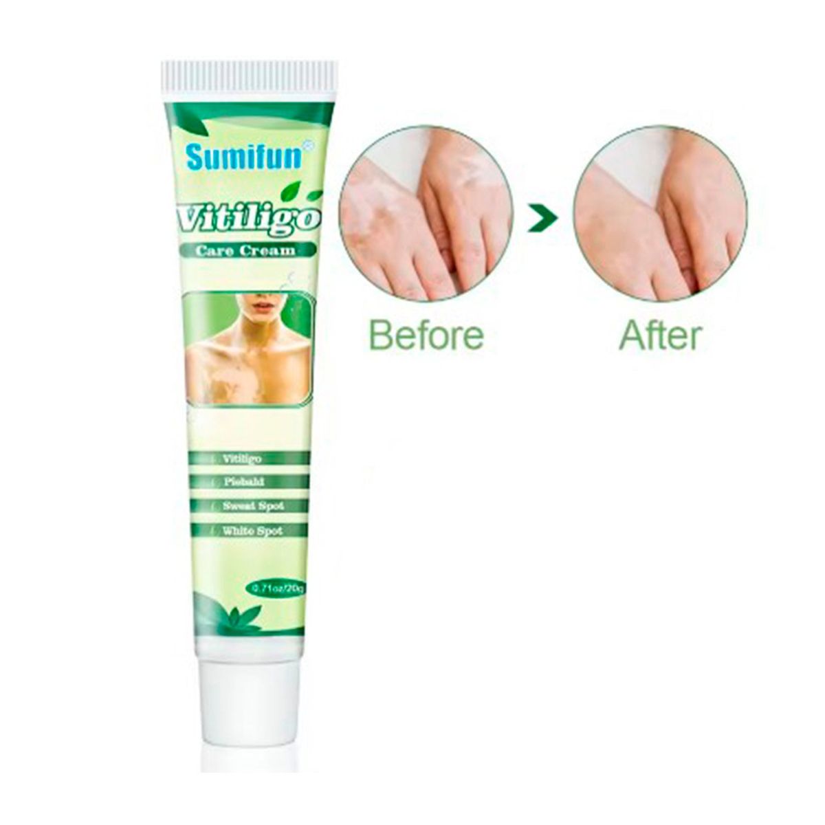 GENERICO - Crema Herbal Para Tratar Vitiligo Manchas Blancas