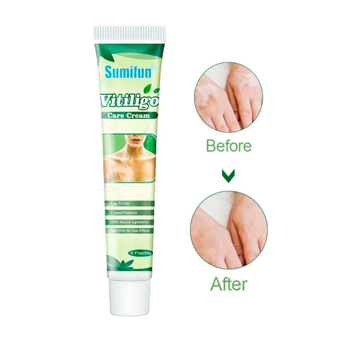 GENERICO - Crema natrual China Para Vitiligo