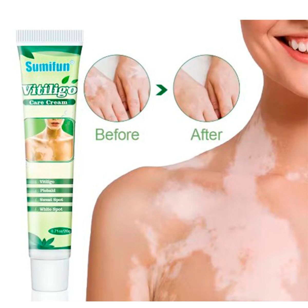 GENERICO - Crema Herbal china Para Tratar Vitiligo