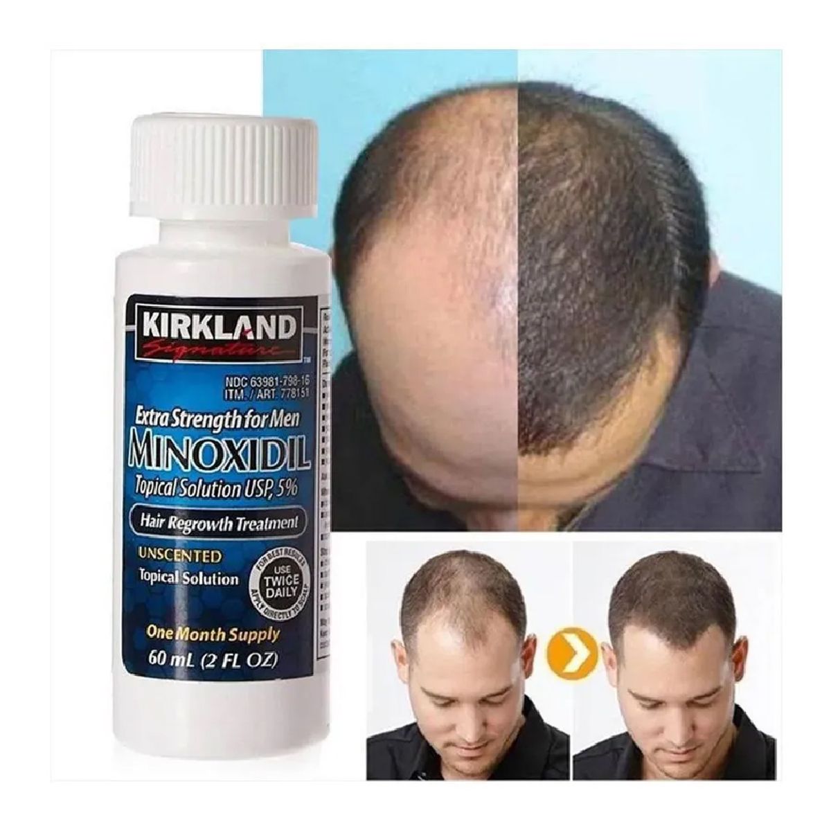 KIRKLAND - Minoxidil Liquido Kirkland 5% Tratamiento Cuero cabelludo - 02 Unid.