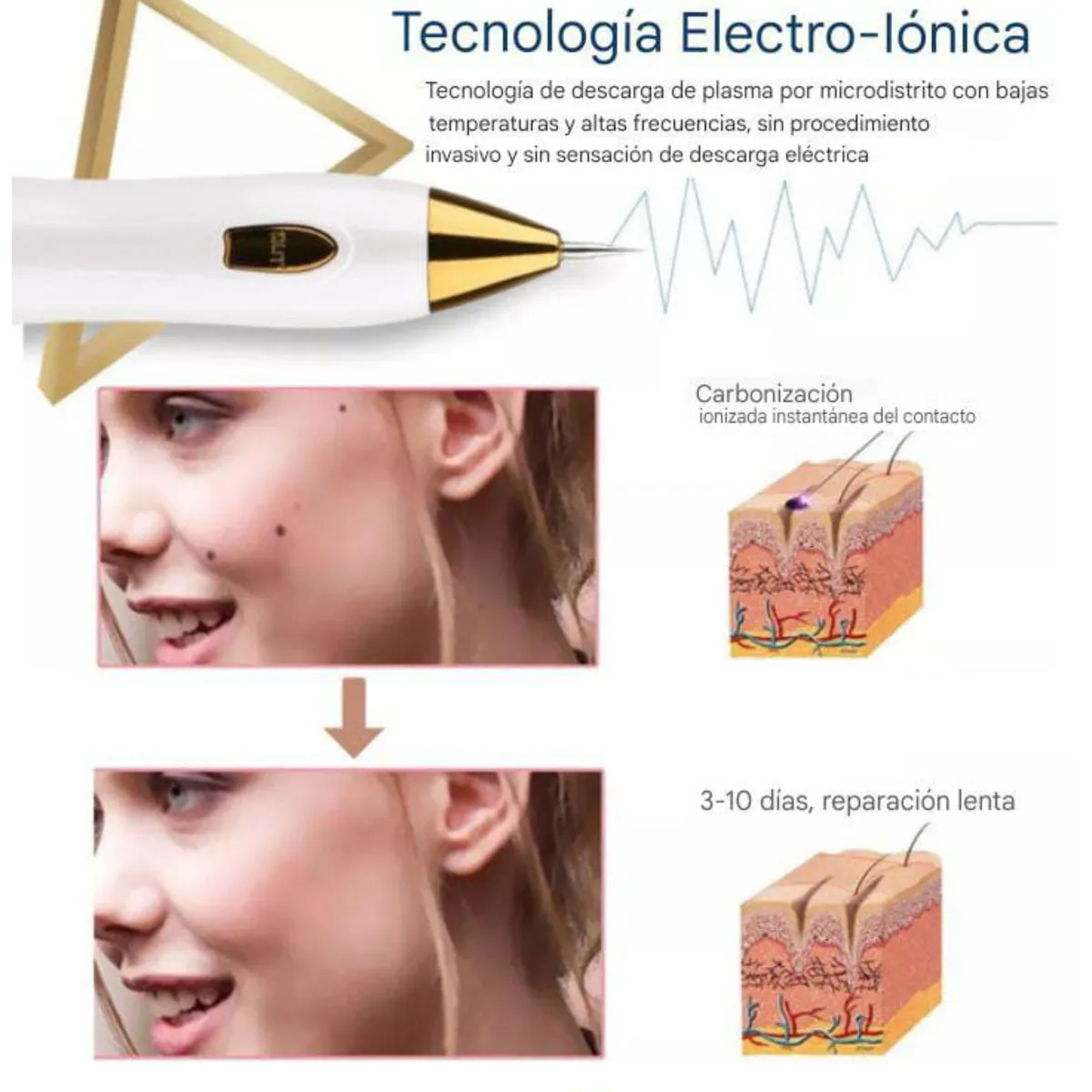 GENERICO - Eliminación de VERRUGAS + LUNARES  Cauterizador plasma RECARGABLE