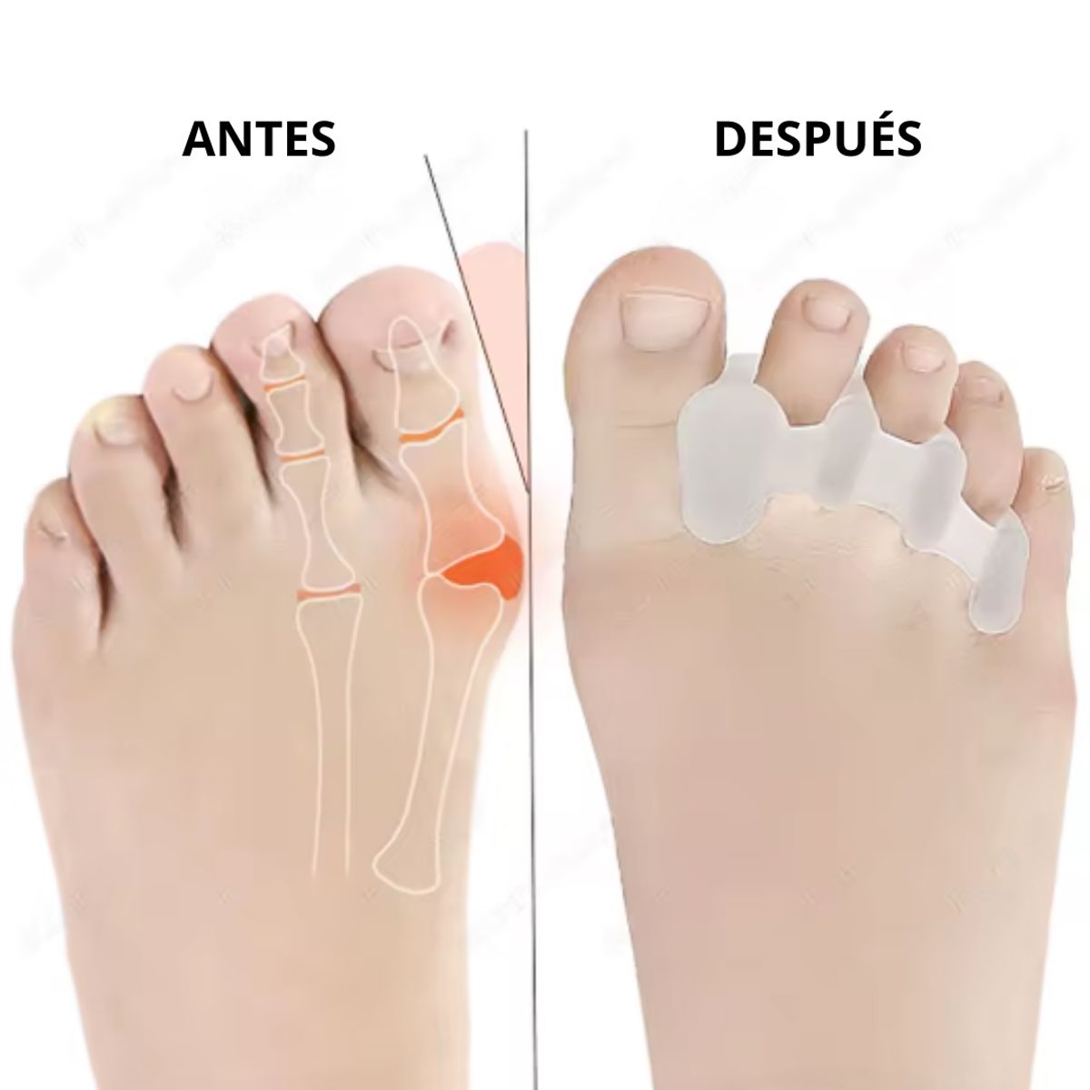 GENERICO - Almohadilla gel dedo gordo separador superpuesto juanete plantilla