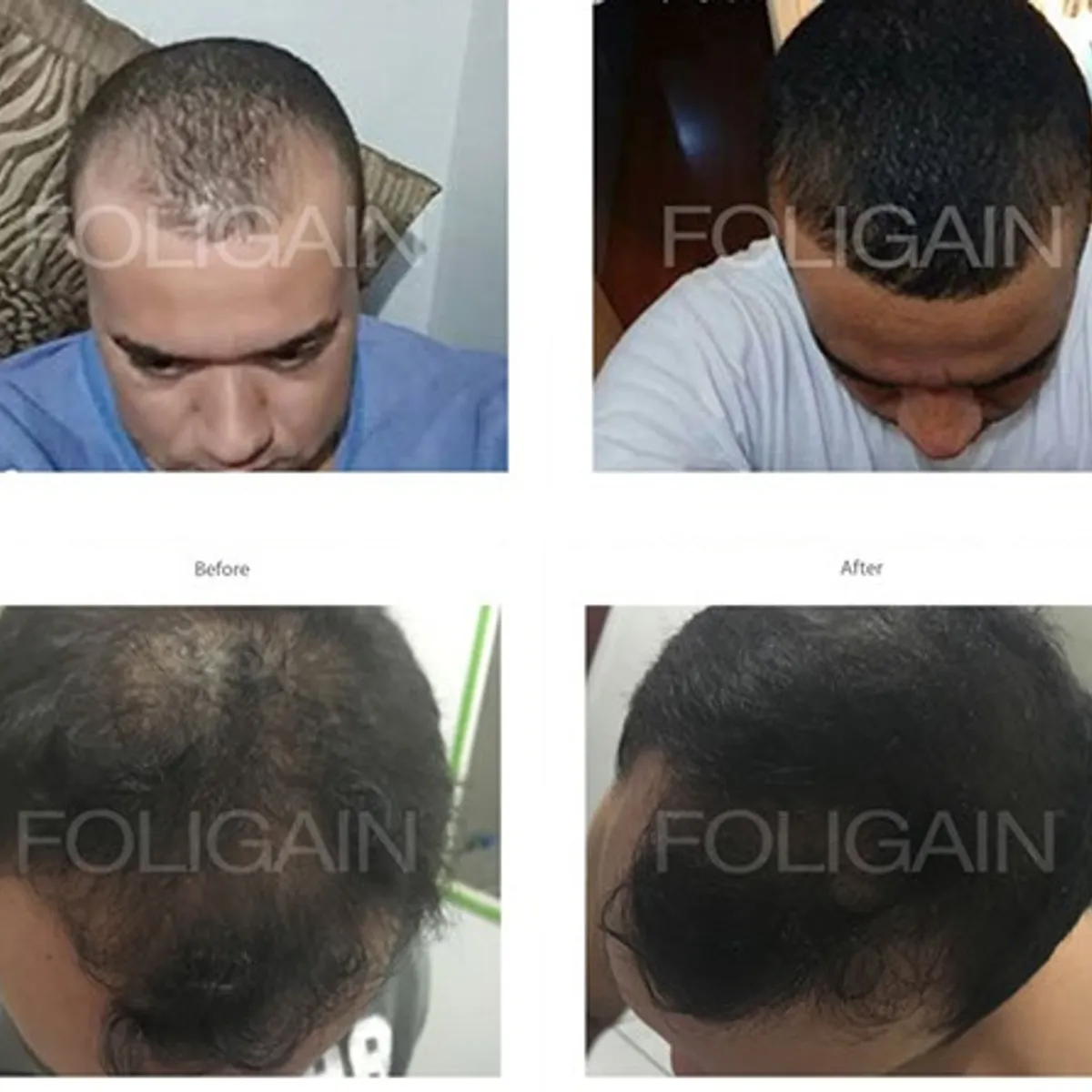 KIRKLAND - Foligain Minoxidil 5% Liquido 60 ml Aumento de Cabello y Barba