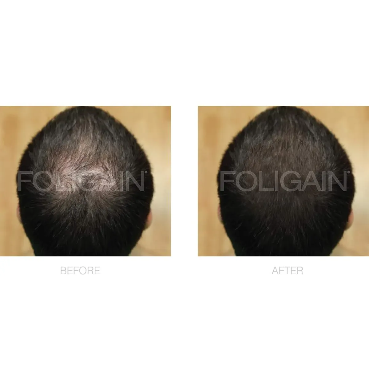 KIRKLAND - Foligain Minoxidil 5% Liquido Aumento Cabello y Barba Pack X3